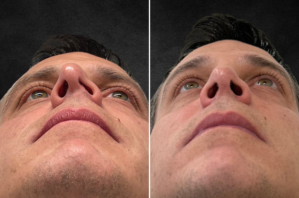 patient-10774-rhinoplasty-before-after