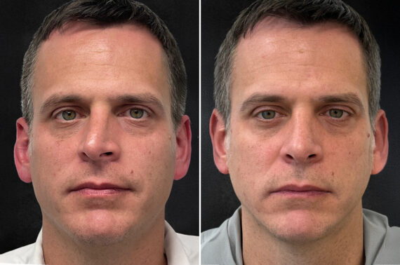 Rhinoplasty Before and After Photos in Philadelphia, PA, Patient 10774