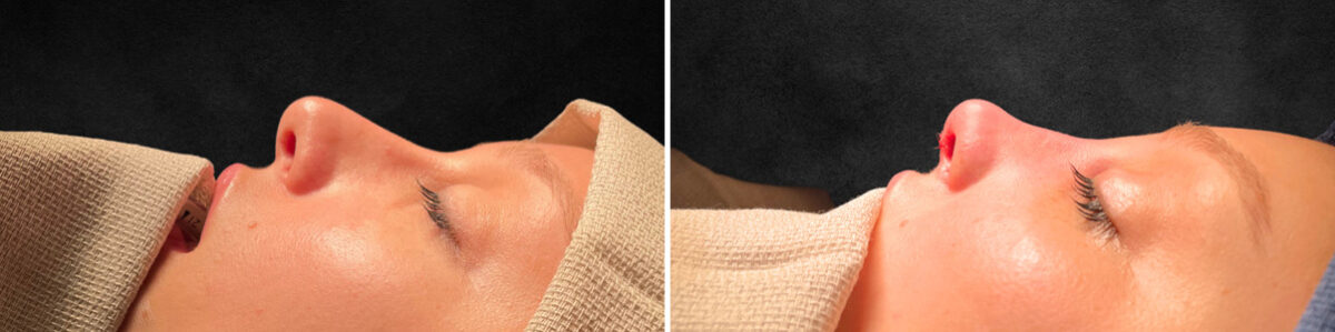 Rhinoplasty Before and After Photos in Philadelphia, PA, Patient 10793