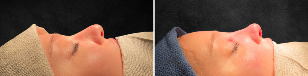 Rhinoplasty Before and After Photos in Philadelphia, PA, Patient 10793