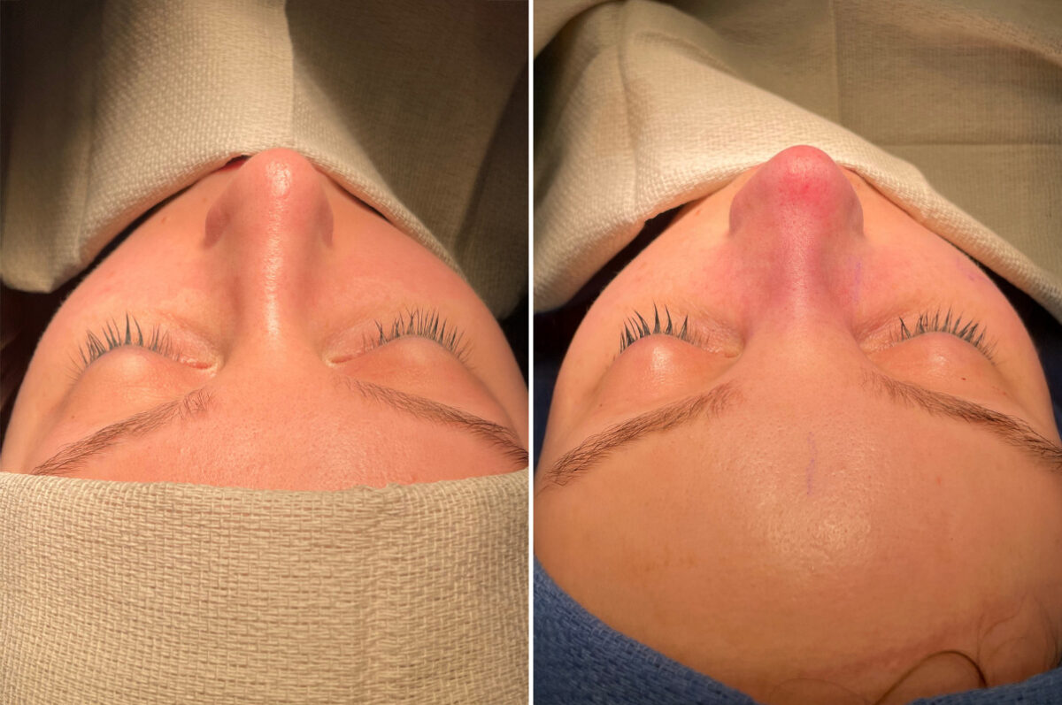 Rhinoplasty Before and After Photos in Philadelphia, PA, Patient 10793