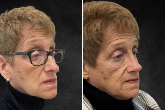 Rhinoplasty Before and After Photos in Philadelphia, PA, Patient 10803