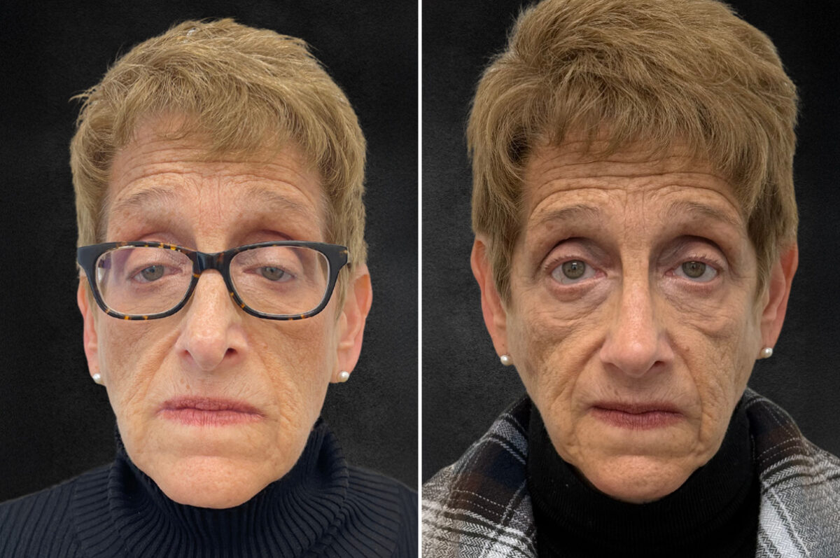 Rhinoplasty Before and After Photos in Philadelphia, PA, Patient 10803