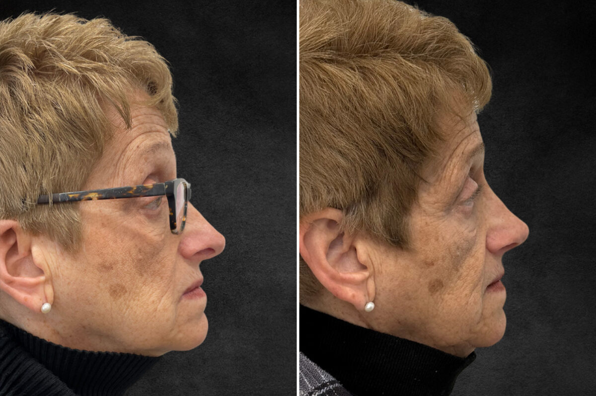 Rhinoplasty Before and After Photos in Philadelphia, PA, Patient 10803