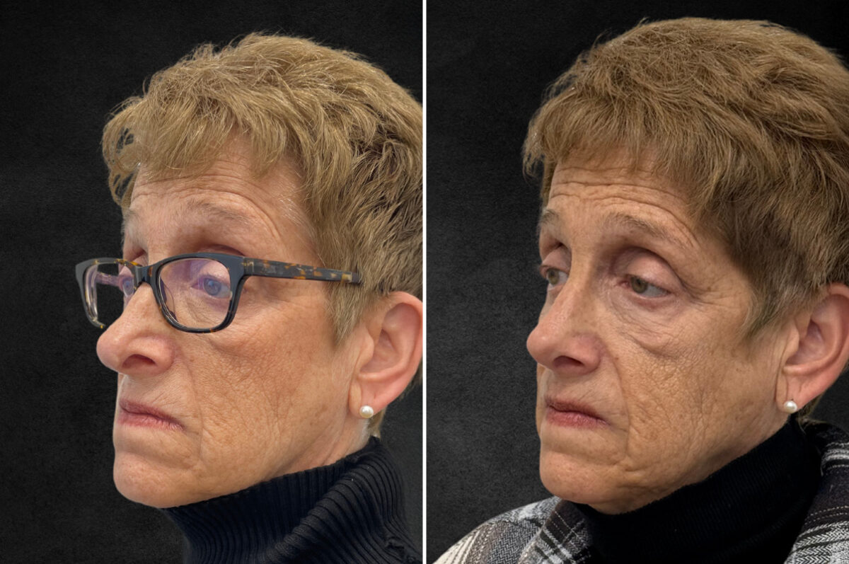 Rhinoplasty Before and After Photos in Philadelphia, PA, Patient 10803