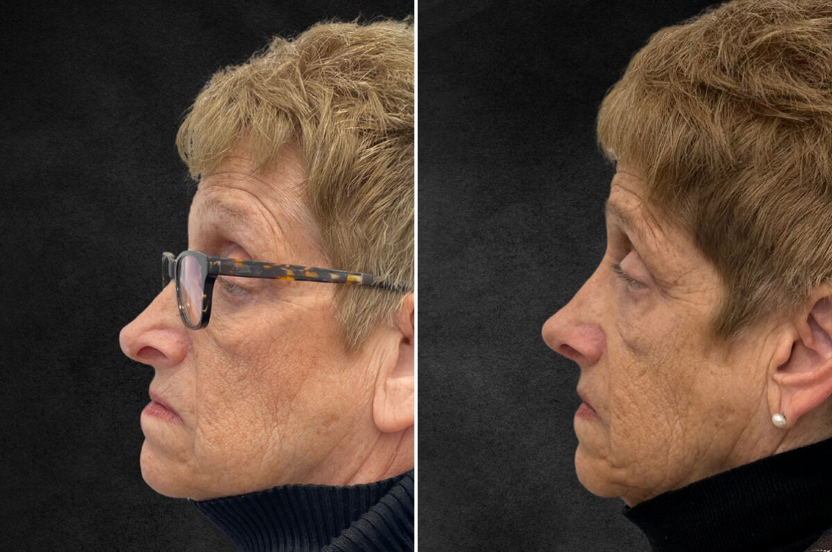 Rhinoplasty Before and After Photos in Philadelphia, PA, Patient 10803