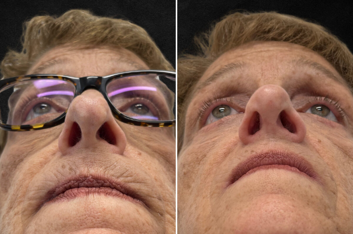 Rhinoplasty Before and After Photos in Philadelphia, PA, Patient 10803