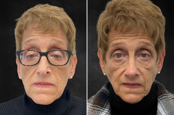 Rhinoplasty Before and After Photos in Philadelphia, PA, Patient 10803