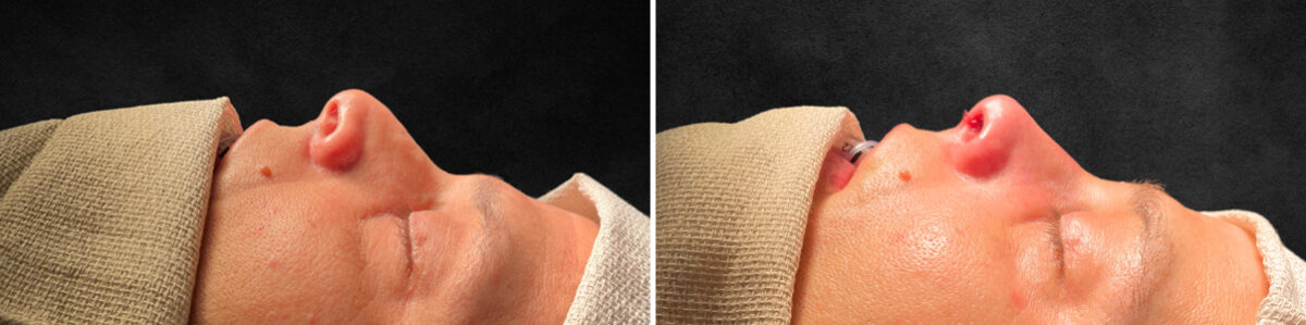 Rhinoplasty Before and After Photos in Philadelphia, PA, Patient 10822