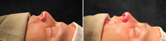 Rhinoplasty Before and After Photos in Philadelphia, PA, Patient 10822