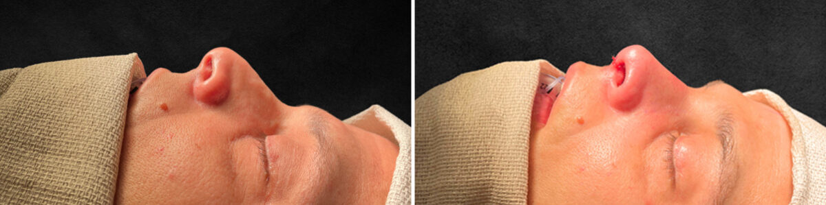 Rhinoplasty Before and After Photos in Philadelphia, PA, Patient 10822
