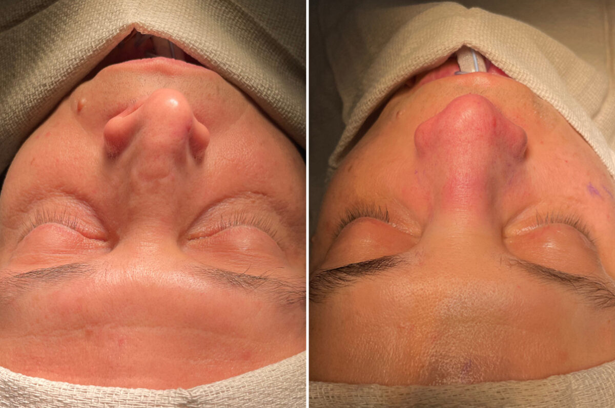 Rhinoplasty Before and After Photos in Philadelphia, PA, Patient 10822