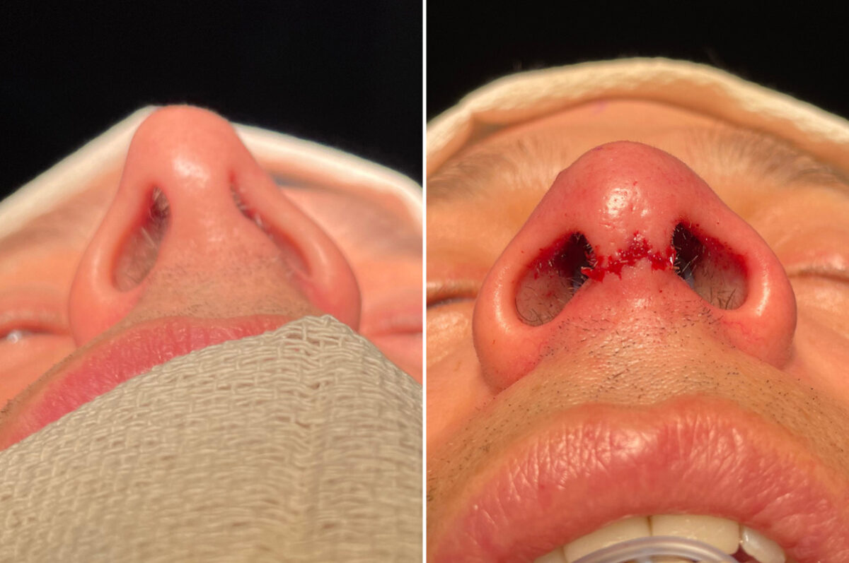 Rhinoplasty Before and After Photos in Philadelphia, PA, Patient 10822