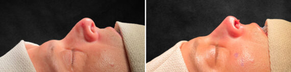 Rhinoplasty Before and After Photos in Philadelphia, PA, Patient 10822