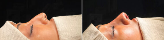 Rhinoplasty Before and After Photos in Philadelphia, PA, Patient 10838