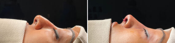 Rhinoplasty Before and After Photos in Philadelphia, PA, Patient 10838