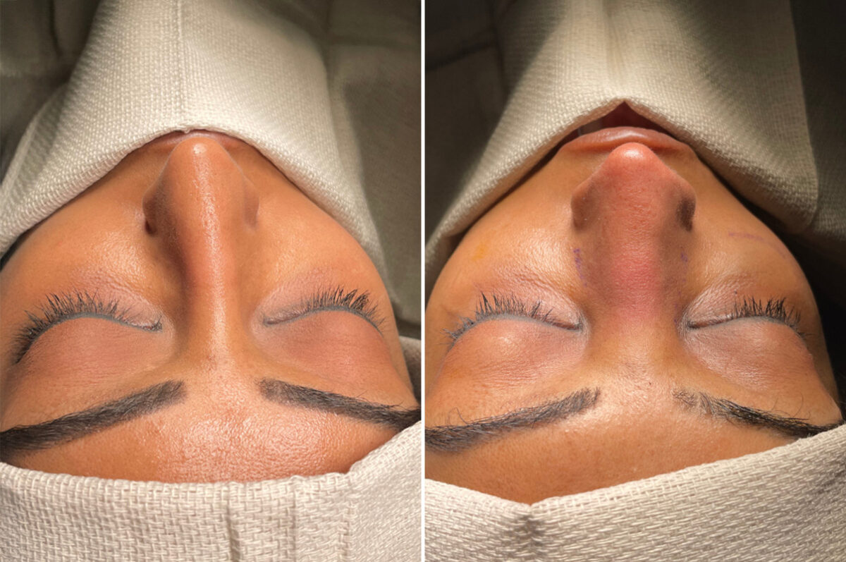 Rhinoplasty Before and After Photos in Philadelphia, PA, Patient 10838
