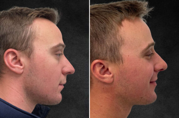 Rhinoplasty Before and After Photos in Philadelphia, PA, Patient 10850