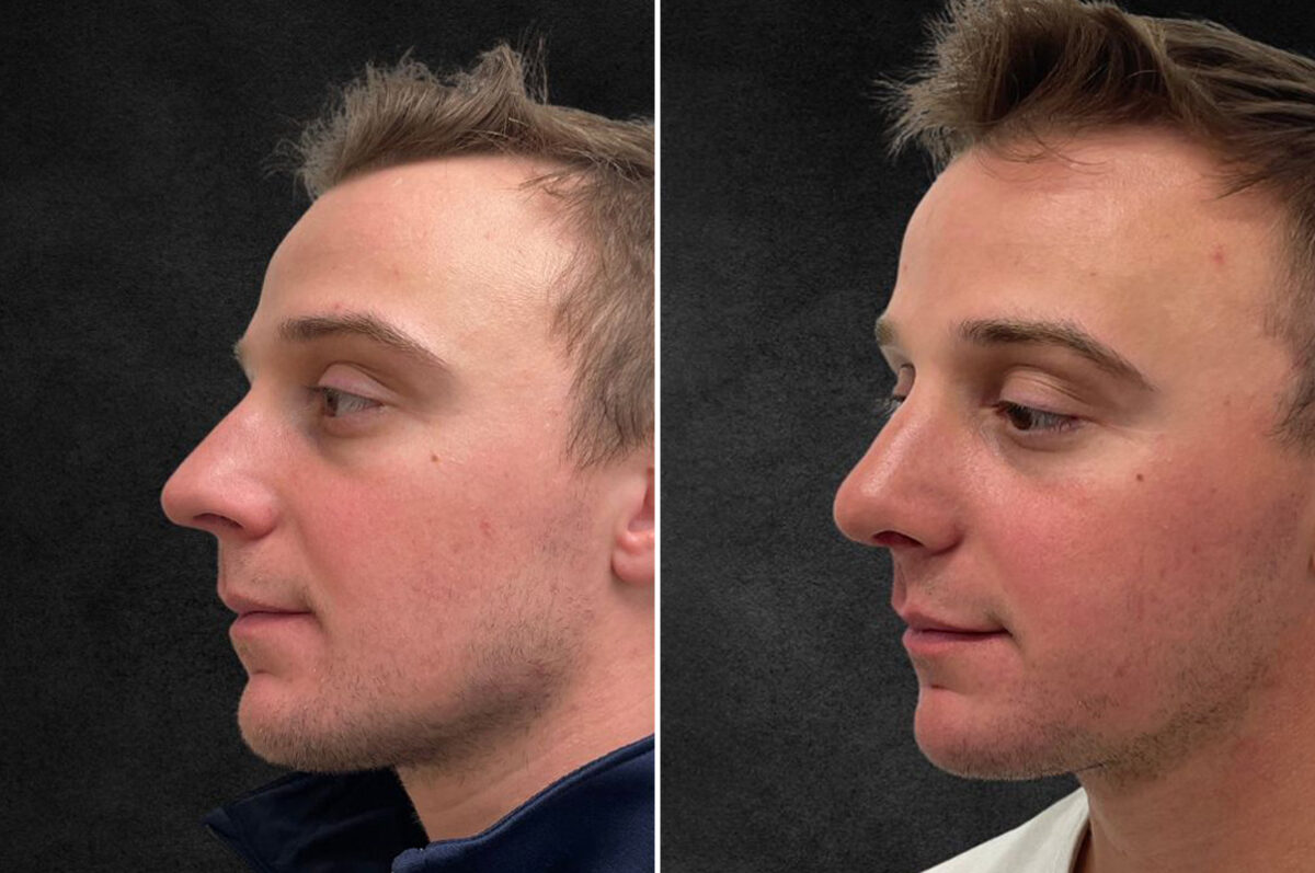 Rhinoplasty Before and After Photos in Philadelphia, PA, Patient 10850
