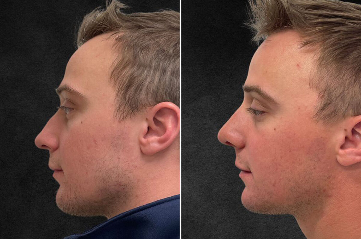 Rhinoplasty Before and After Photos in Philadelphia, PA, Patient 10850