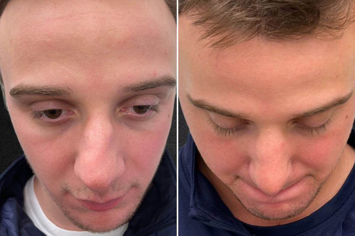 Rhinoplasty Before and After Photos in Philadelphia, PA, Patient 10850