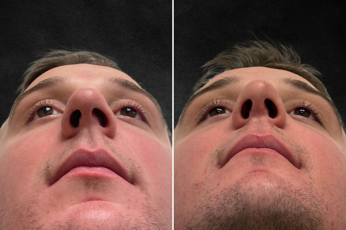 Rhinoplasty Before and After Photos in Philadelphia, PA, Patient 10850