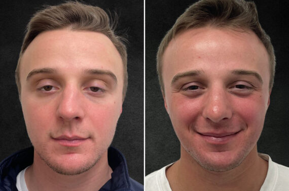 Rhinoplasty Before and After Photos in Philadelphia, PA, Patient 10850