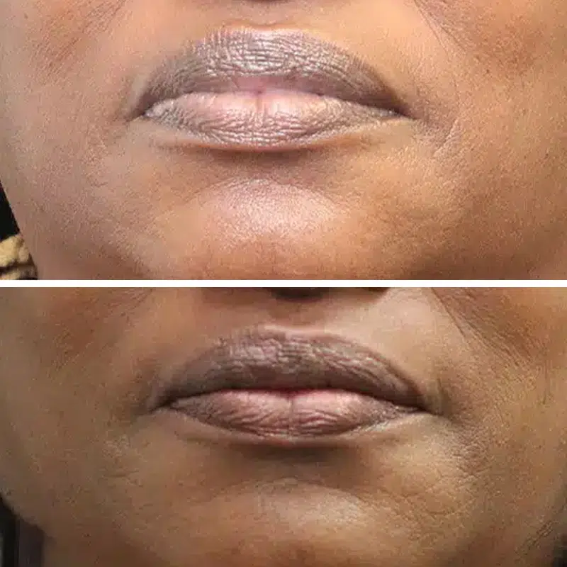 Before & After photos Dr. Becker