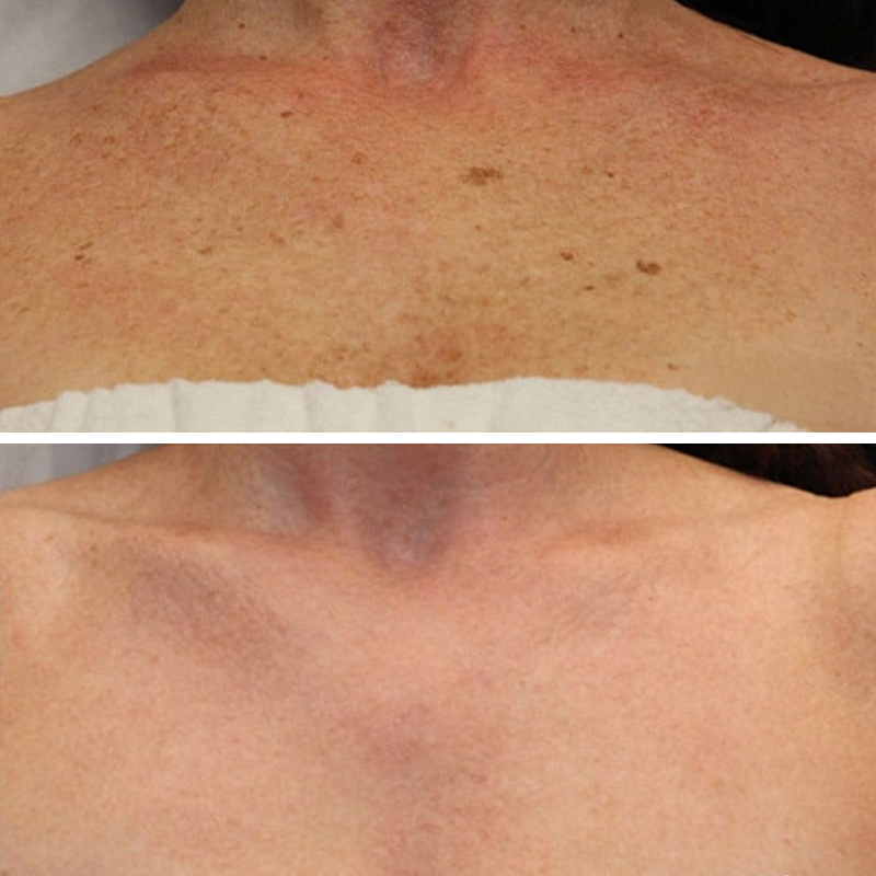 Before & After Photos Samantha Berry, RN