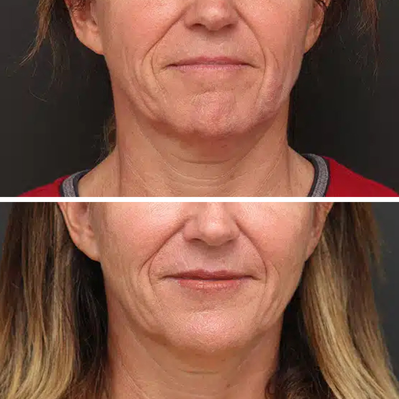 Before & After Photos Samantha Berry, RN