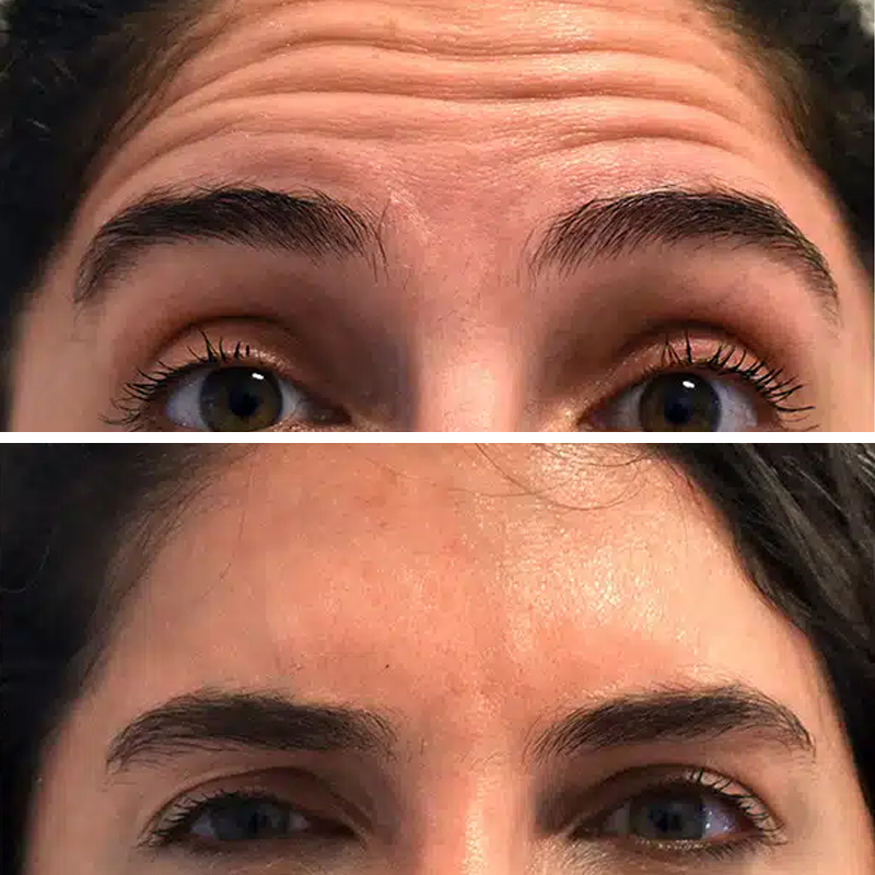 Before & After Photos Brooke Carrero, RN