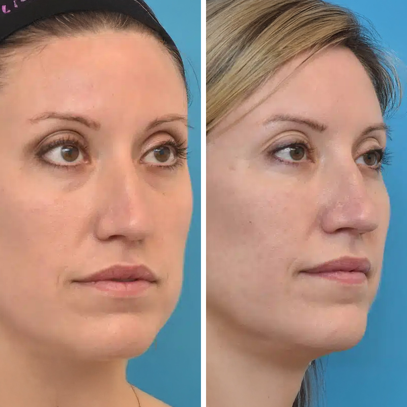 Before & After Photos Brooke Carrero, RN