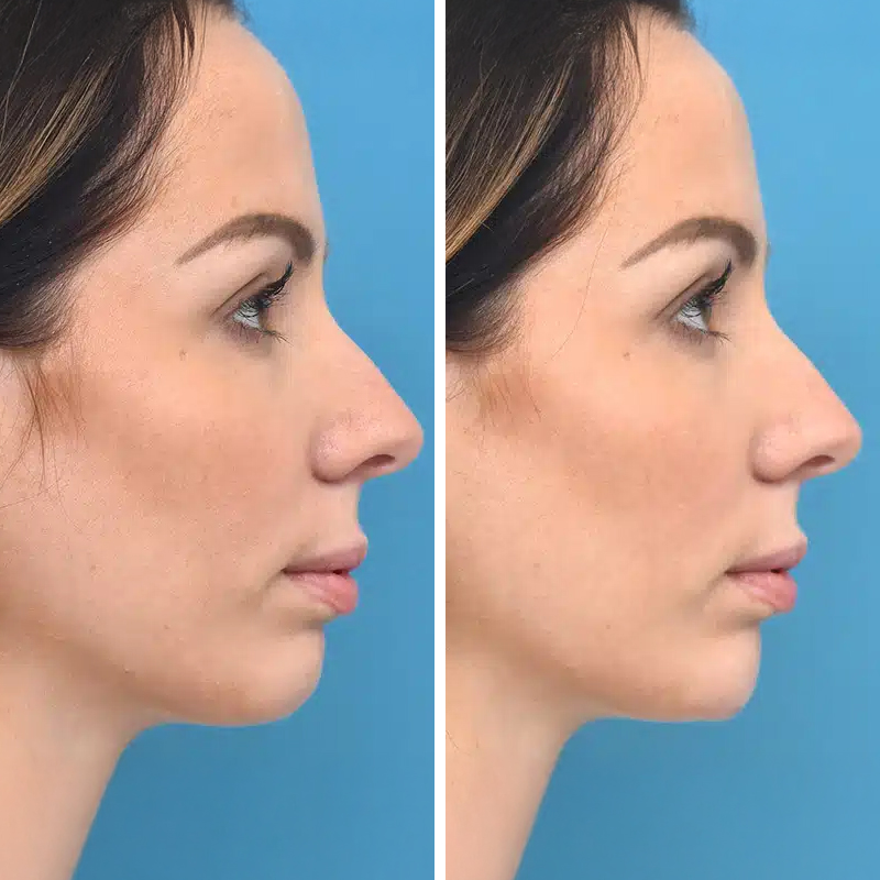 Before & After Photos Brooke Carrero, RN