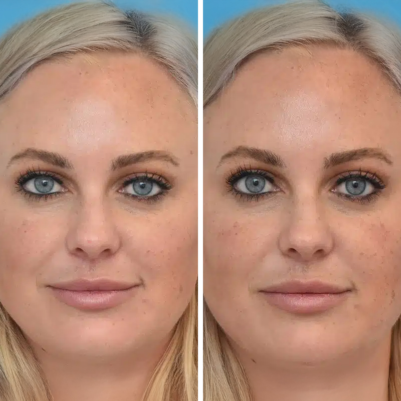 Before & After Photos Brooke Carrero, RN