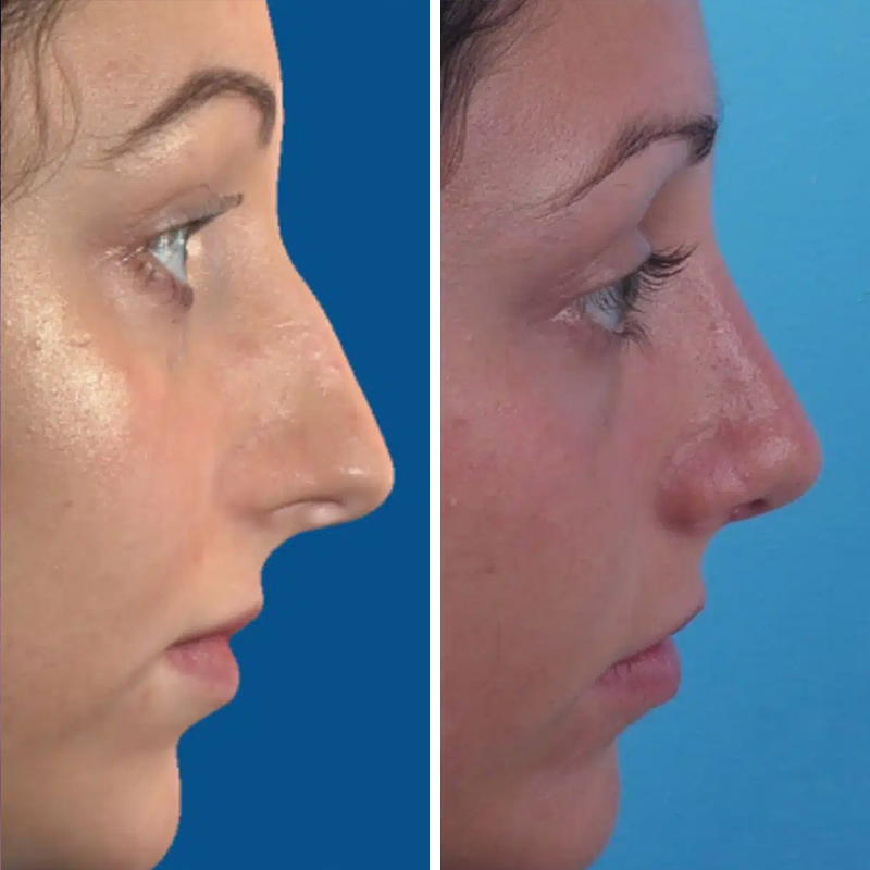 Before & After photos Dr. Becker