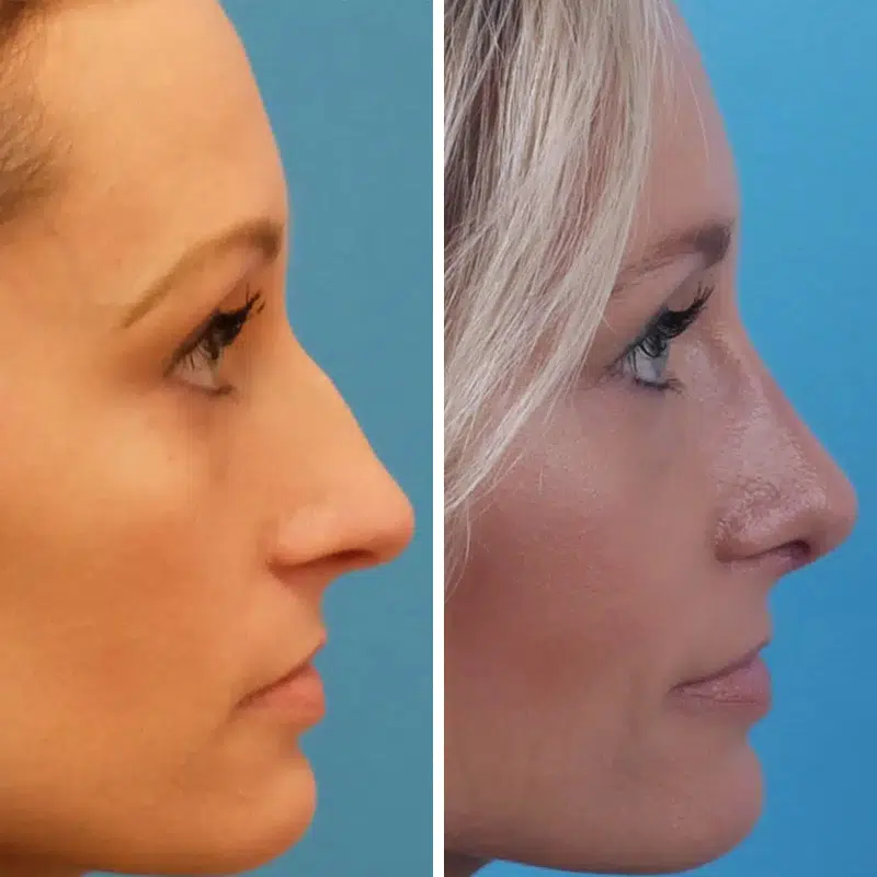 Before & After photos Dr. Becker