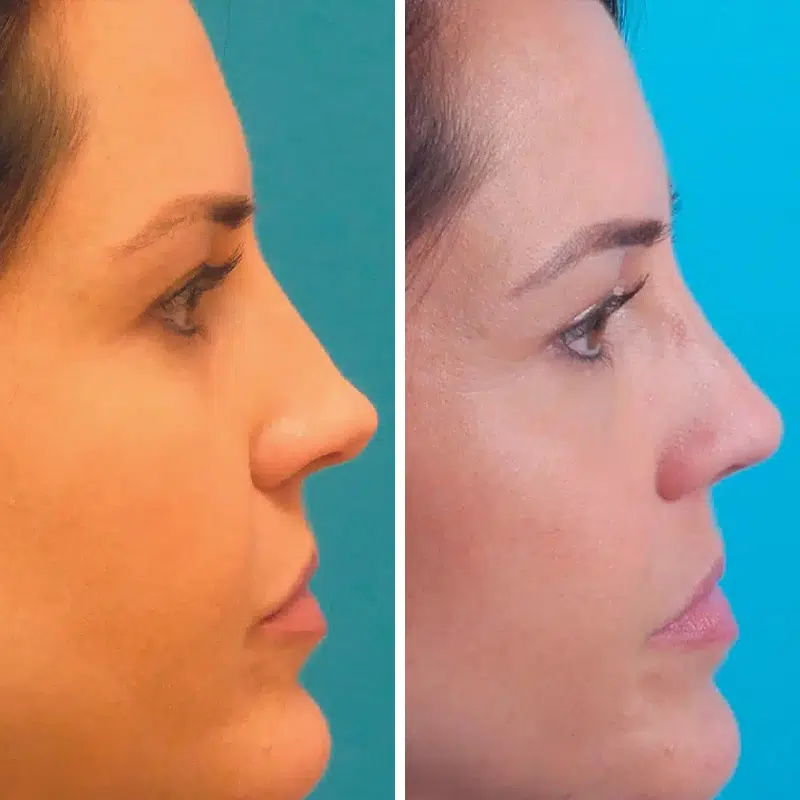 Before & After photos Dr. Becker