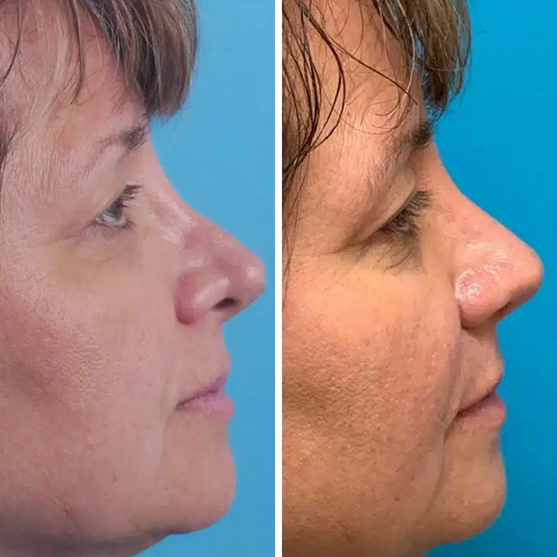 Before & After photos Dr. Becker