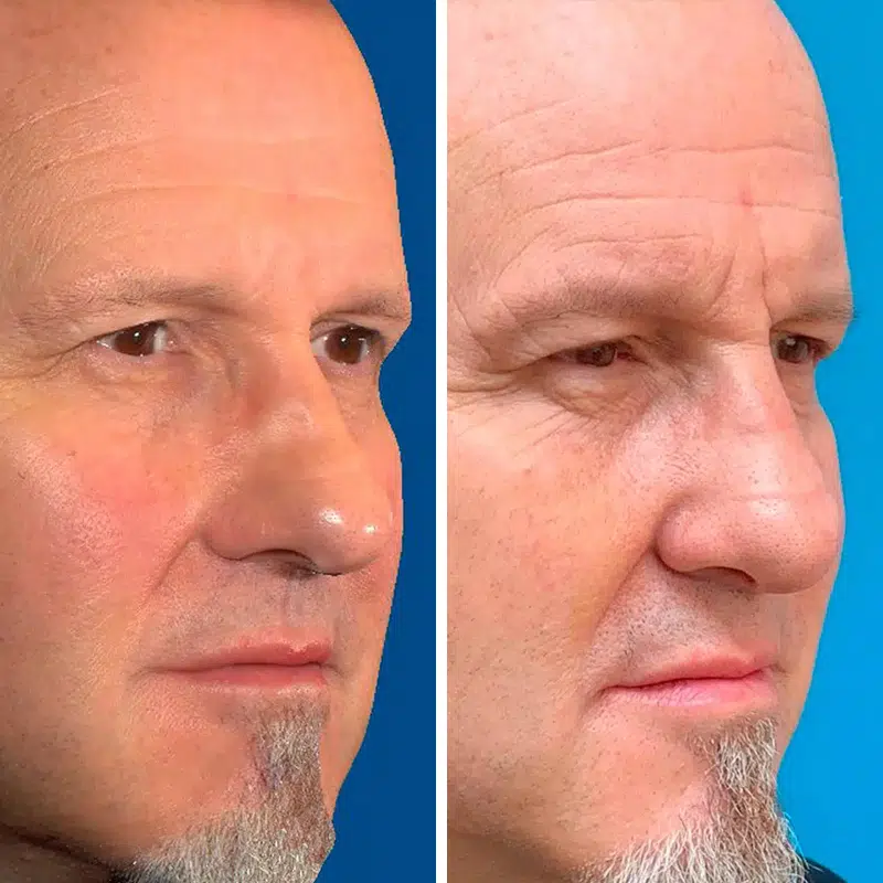 Before & After photos Dr. Becker