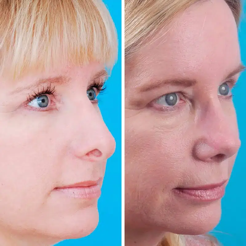 Before & After photos Dr. Becker