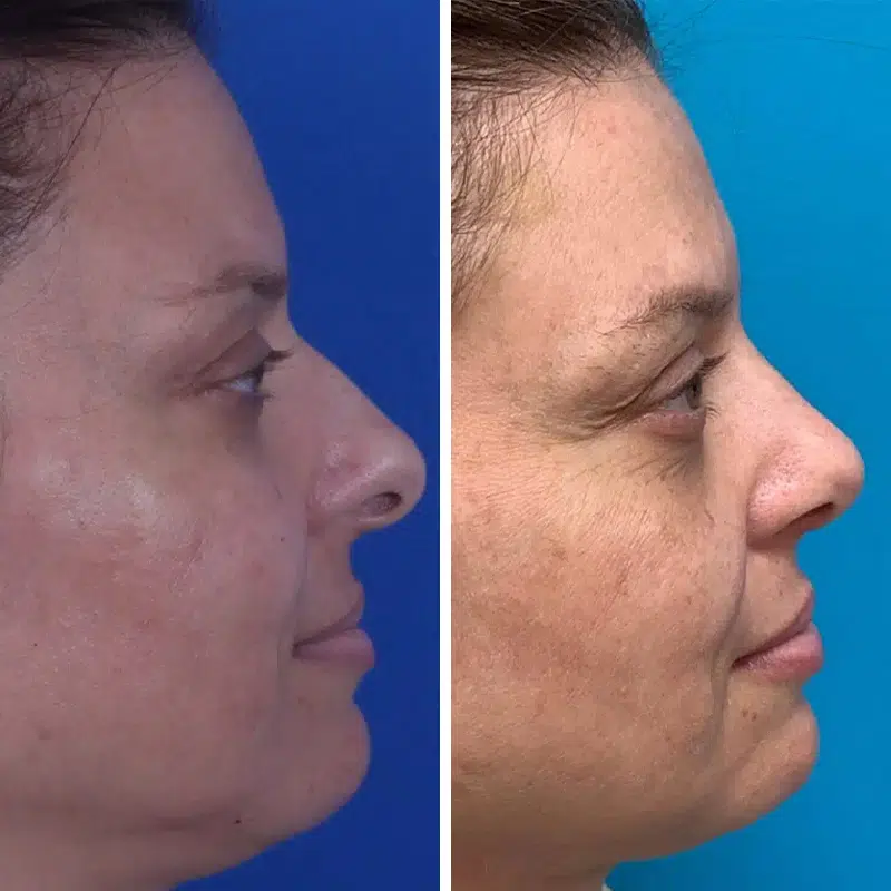 Before & After photos Dr. Becker