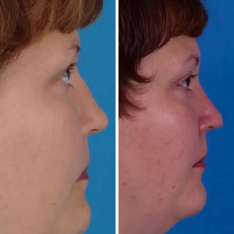 Before & After photos Dr. Becker