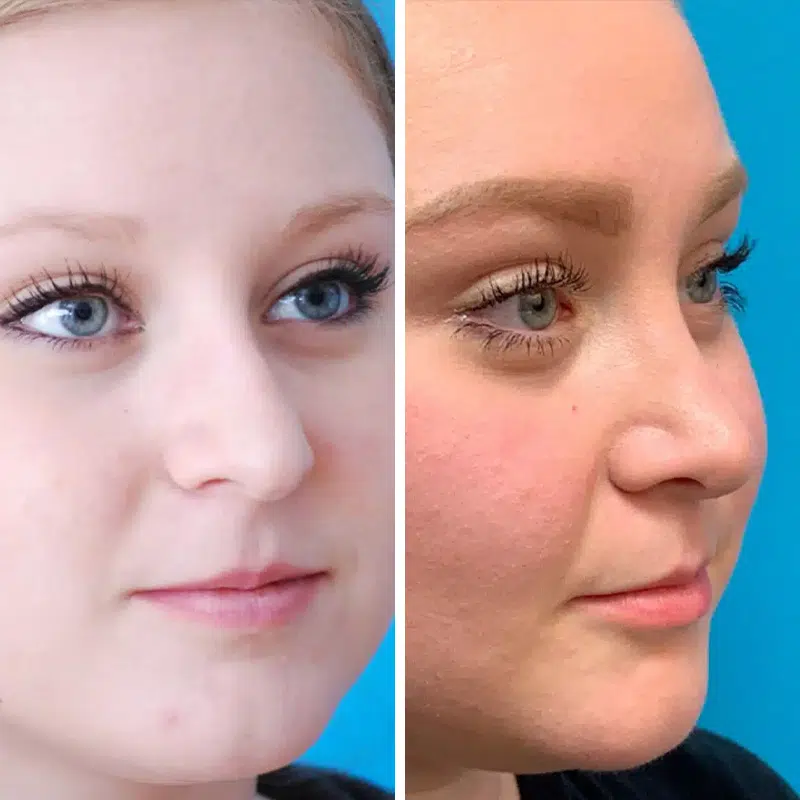 Before & After photos Dr. Becker