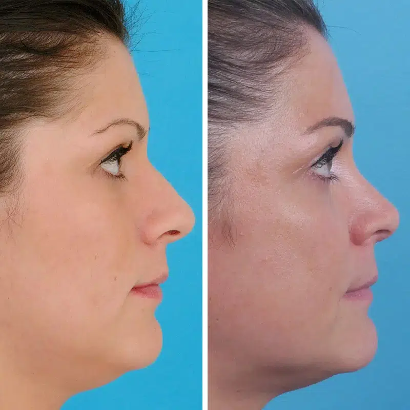 Before & After photos Dr. Becker