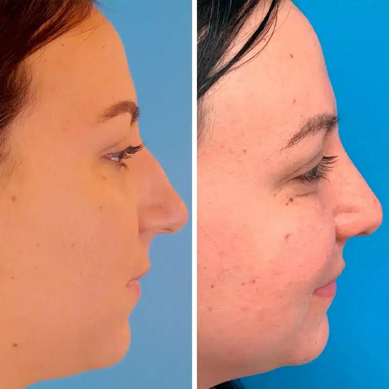 Before & After photos Dr. Becker