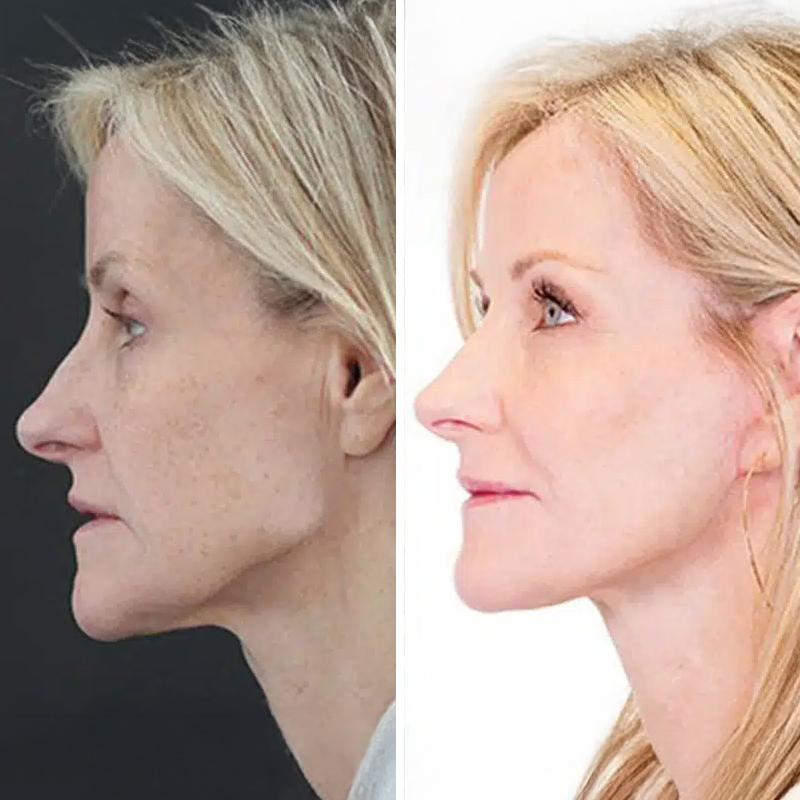 Before & After Photos Nicole Schrader, MD, FACS