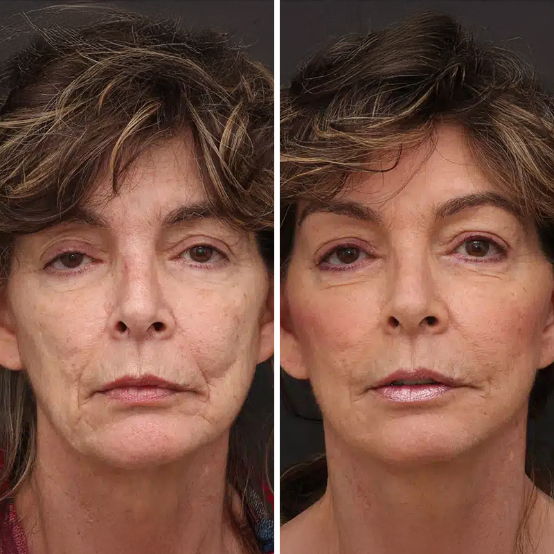Before & After Photos Nicole Schrader, MD, FACS