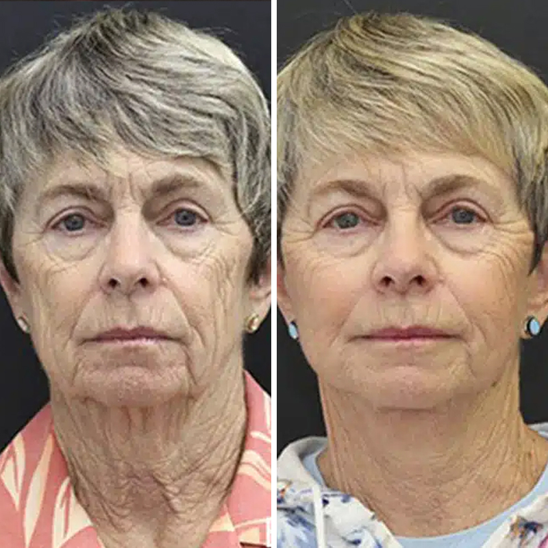 Before & After Photos Nicole Schrader, MD, FACS