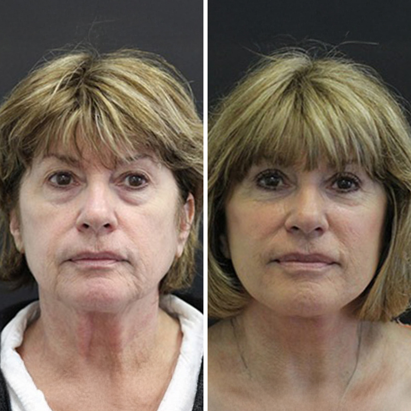 Before & After Photos Nicole Schrader, MD, FACS
