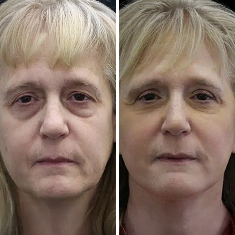 Before & After Photos Nicole Schrader, MD, FACS